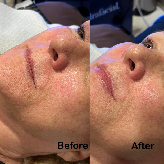 Studio Booth Hydrafacial work in Pittsburgh