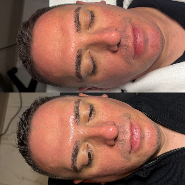 Studio Booth Hydrafacial work in Pittsburgh